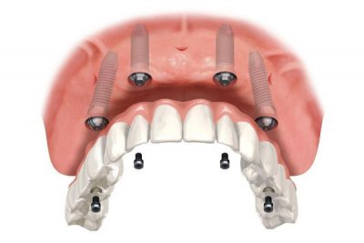 divide Especialização Prótese Dentária com ênfase em Prótese sobre Implantes e Estética
